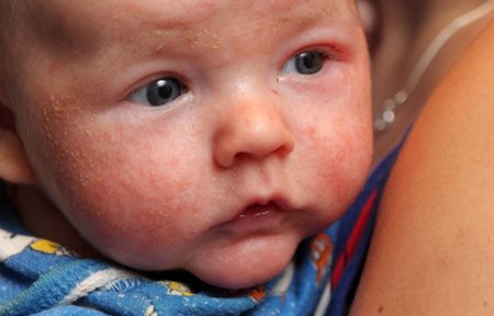 Gezicht van een baby met een schilferige, rode huid.
