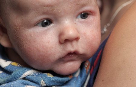 Baby met een blanke huid met atopische dermatitis