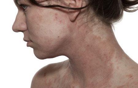 Het gezicht en het decolleté van een blanke vrouw met atopische dermatitis