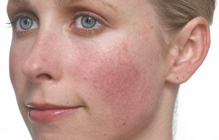 Het gezicht van een vrouw met een blanke huid en rosacea