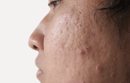 Close-up van een gezicht met acne