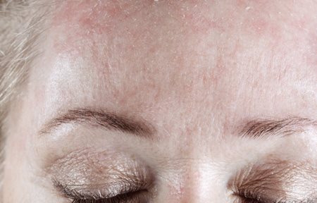 Het schilferige voorhoofd van een vrouw